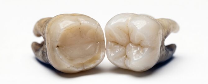 Studio dentistico De Vecchi Mapelli Paullo - Bruxismo: come capire se stringi i denti di notte (e come proteggerli)